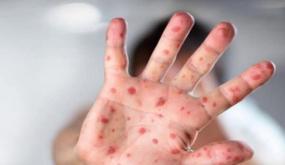 تسجيل 120 وفاة في حدود يوم الأحد المنصرم..اليوبي يعلن تحول “بوحمرون” إلى وباء في المغرب