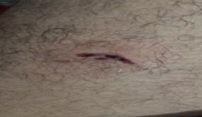 رئيس جمعية المستقبل لحماية المستهلكين بالدشيرة تعرض لعضة كلب والمكتب الصحي لا يتوفر على المصل