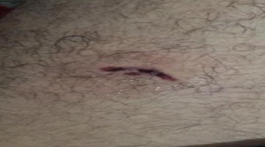 رئيس جمعية المستقبل لحماية المستهلكين بالدشيرة تعرض لعضة كلب والمكتب الصحي لا يتوفر على المصل