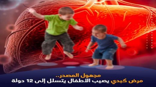 تسجيل أزيد من 170 إصابة بالتهاب الكبد حسب منظمة الصحة العالمية